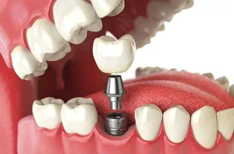Dental implant