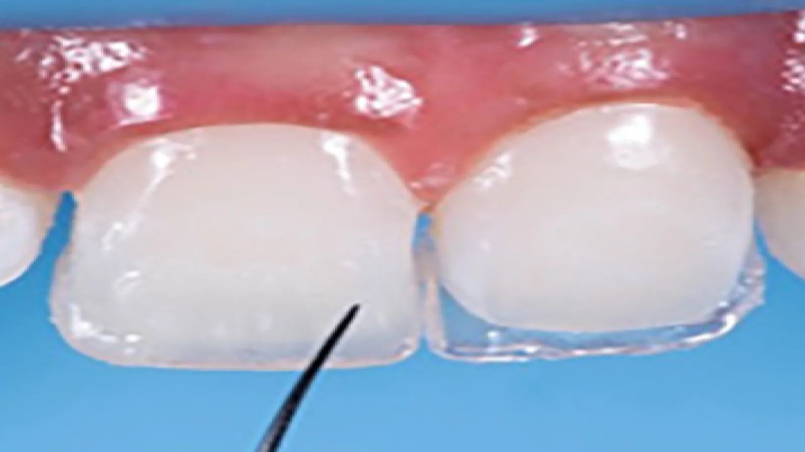 Direct Composite