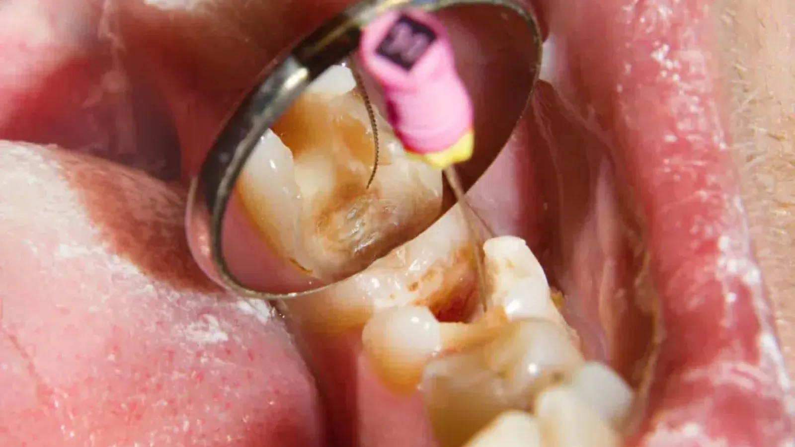 Root Canal Treatment