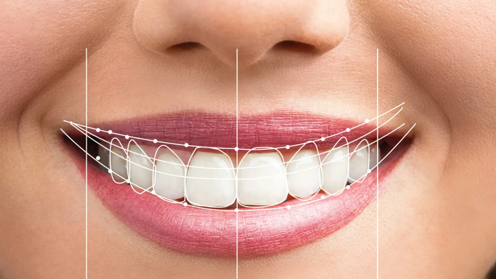 Smile Design
