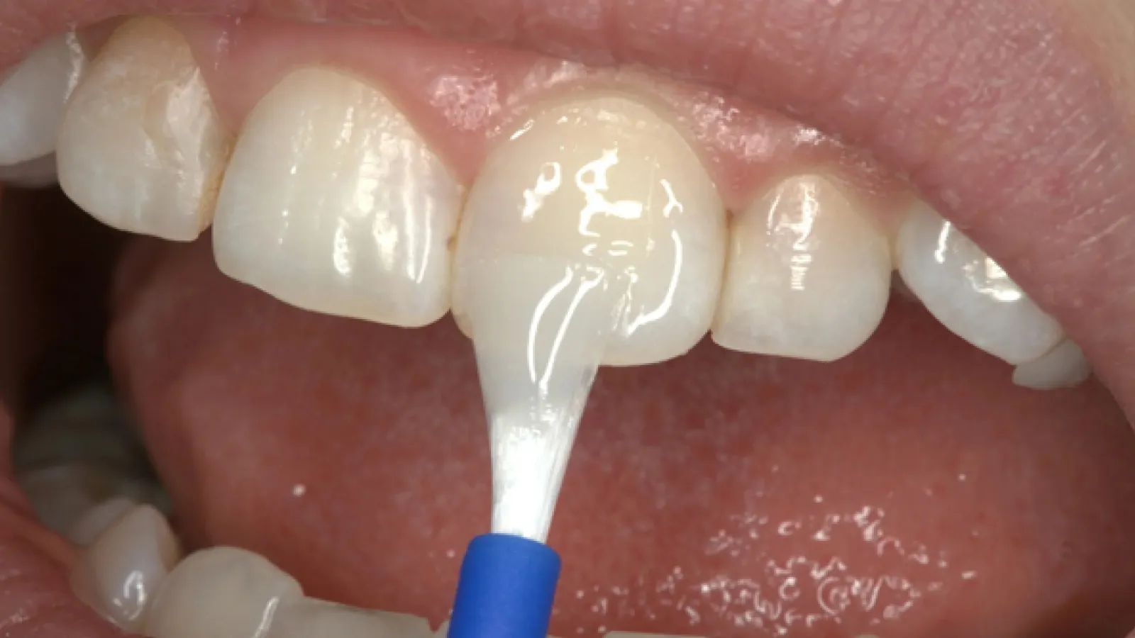 Topical Fluoride