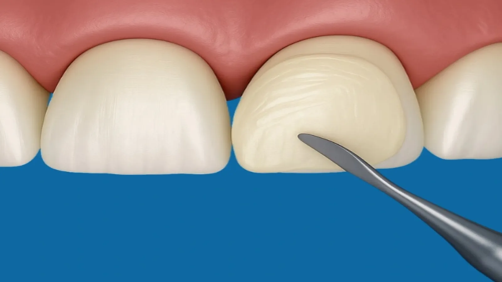 Veneer Composite