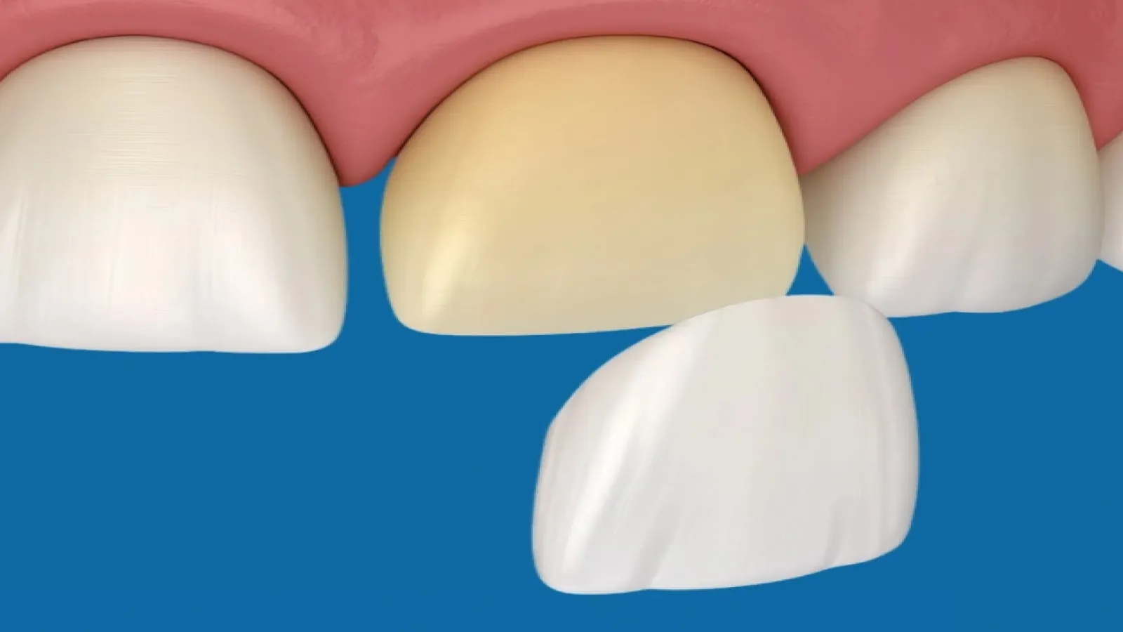 Veneer Porcelain